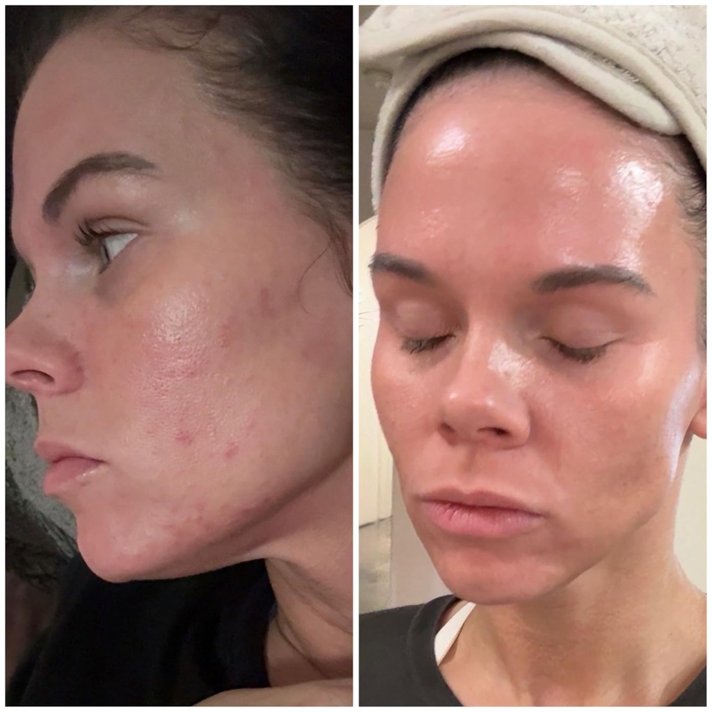 BYOMA Milky Toner Before and After Acne Skin Transformation