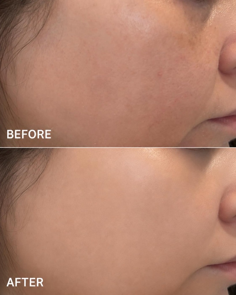 medicube PDRN Serum Cheek Redness and Dark Spots Before and After Transformation