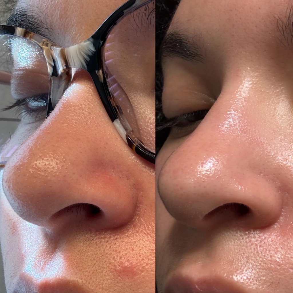 medicube PDRN Serum Nose Pore and Texture Before and After Transformation