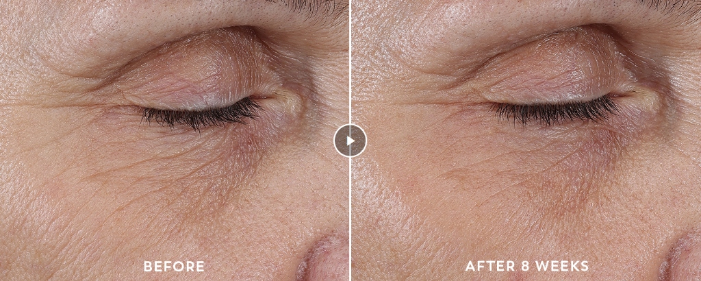 Clinical 8-Week Before and After Eye Wrinkles with Olay Regenerist